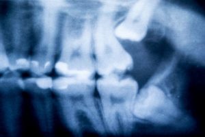 X-Ray of Wisdom Teeth